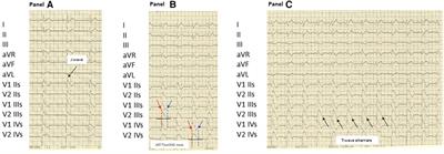Non-invasive cardiac activation mapping and identification of severity of epicardial substrate in Brugada Syndrome: a case report